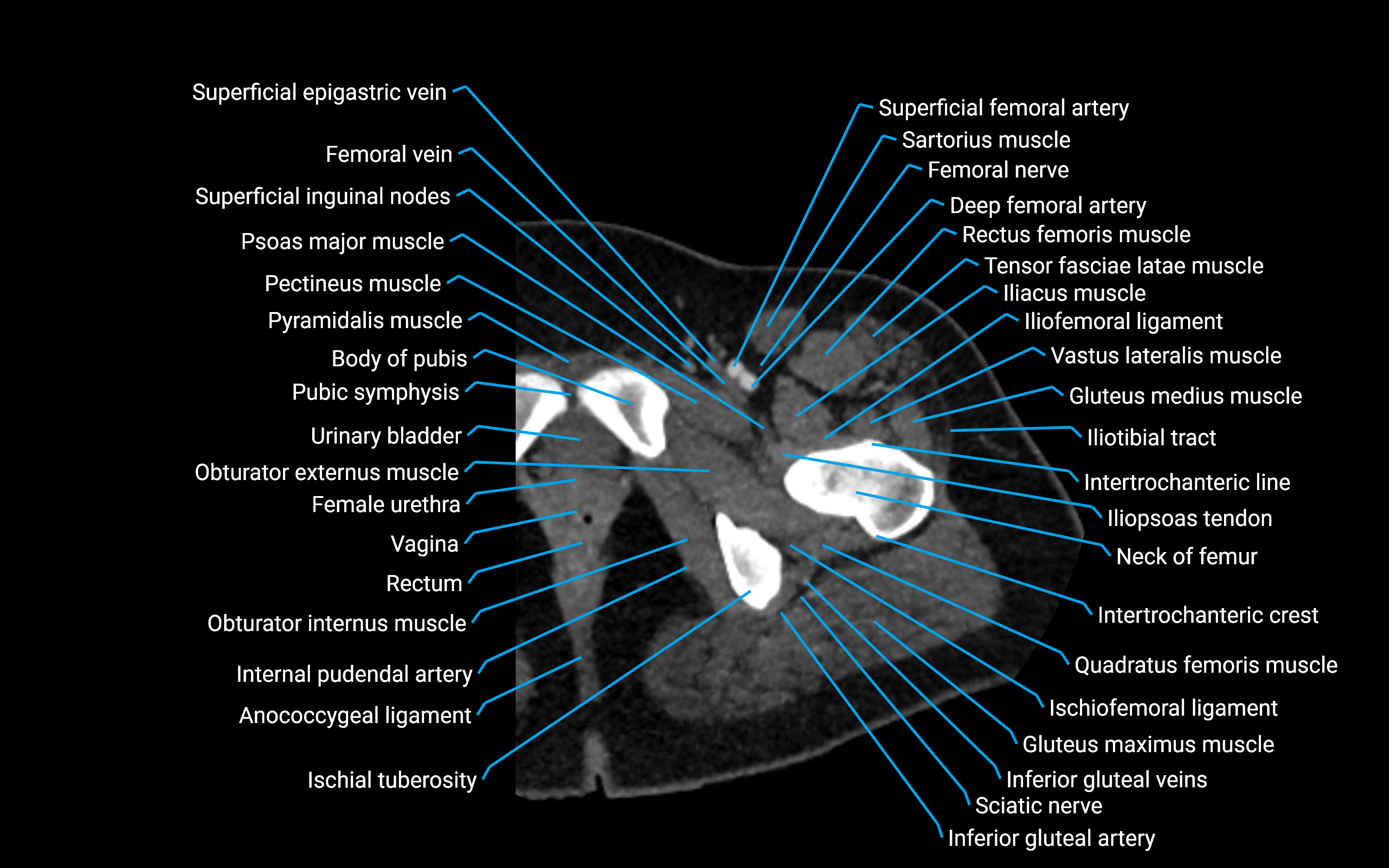 CT Hip axial cross sectional anatomy labelled image 12 (1).png